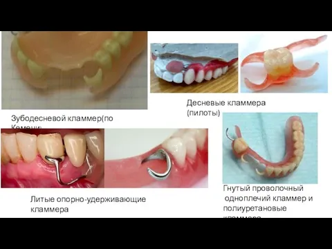 Зубодесневой кламмер(по Кемени) Десневые кламмера (пилоты) Литые опорно-удерживающие кламмера Гнутый проволочный одноплечий кламмер и полиуретановые кламмера