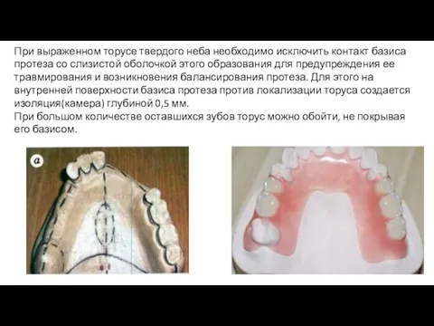 При выраженном торусе твердого неба необходимо исключить контакт базиса протеза со