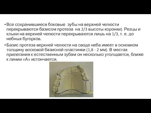 Все сохранившиеся боковые зубы на верхней челюсти перекрываются базисом протеза на