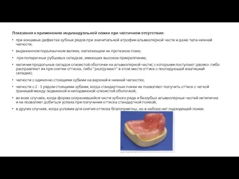 Показания к применению индивидуальной ложки при частичном отсутствии: при концевых дефектах