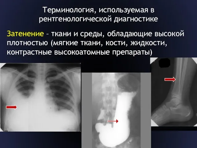 Терминология, используемая в рентгенологической диагностике Затенение – ткани и среды, обладающие