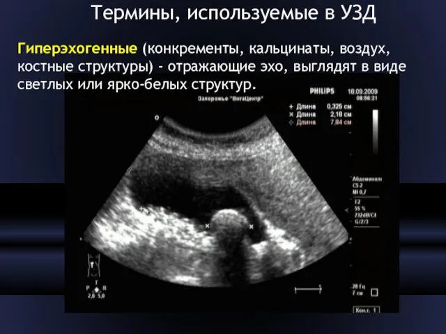 Термины, используемые в УЗД Гиперэхогенные (конкременты, кальцинаты, воздух, костные структуры) -