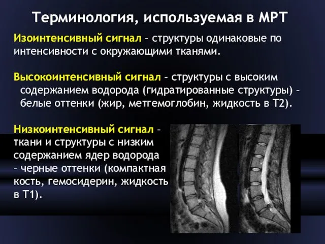 Терминология, используемая в МРТ Изоинтенсивный сигнал – структуры одинаковые по интенсивности