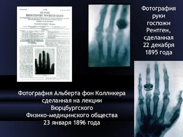 Фотография руки госпожи Рентген, сделанная 22 декабря 1895 года Фотография Альберта