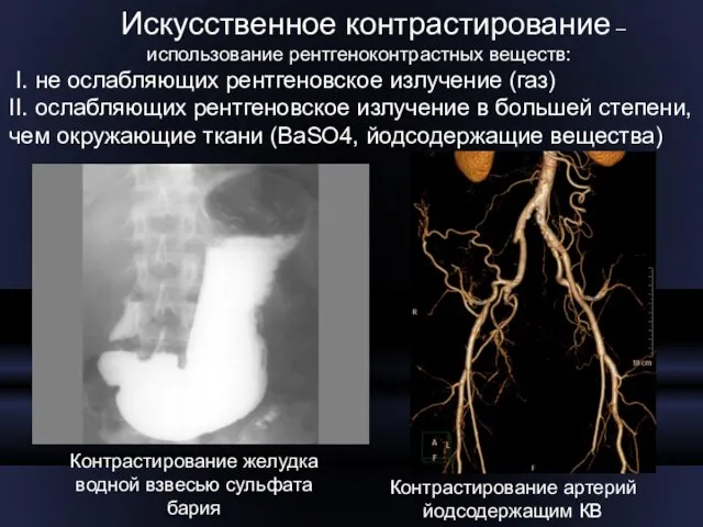 Искусственное контрастирование – использование рентгеноконтрастных веществ: I. не ослабляющих рентгеновское излучение