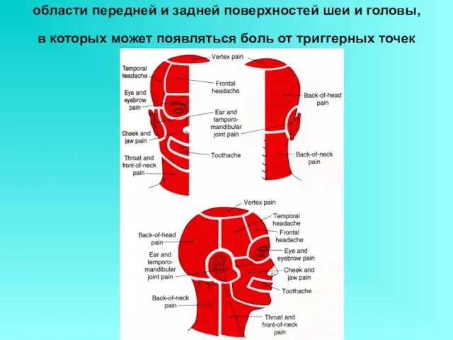 области передней и задней поверхностей шеи и головы, в которых может появляться боль от триггерных точек