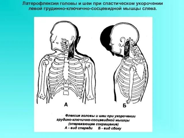 Латерофлексия головы и шеи при спастическом укорочении левой грудинно-ключично-сосцевидной мышцы слева.