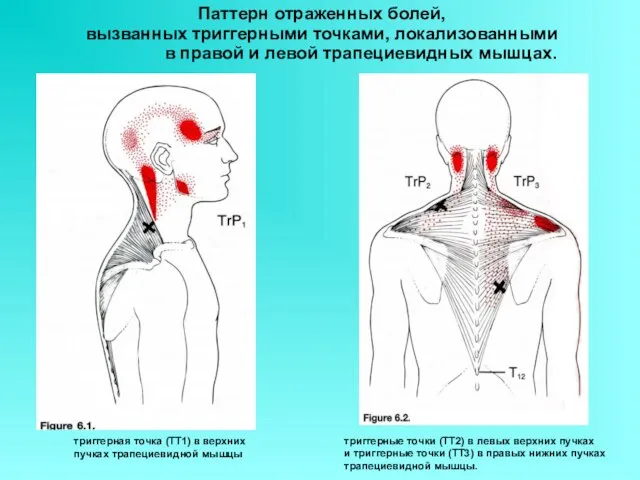 Паттерн отраженных болей, вызванных триггерными точками, локализованными в правой и левой