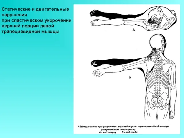 Статические и двигательные нарушения при спастическом укорочении верхней порции левой трапециевидной мышцы