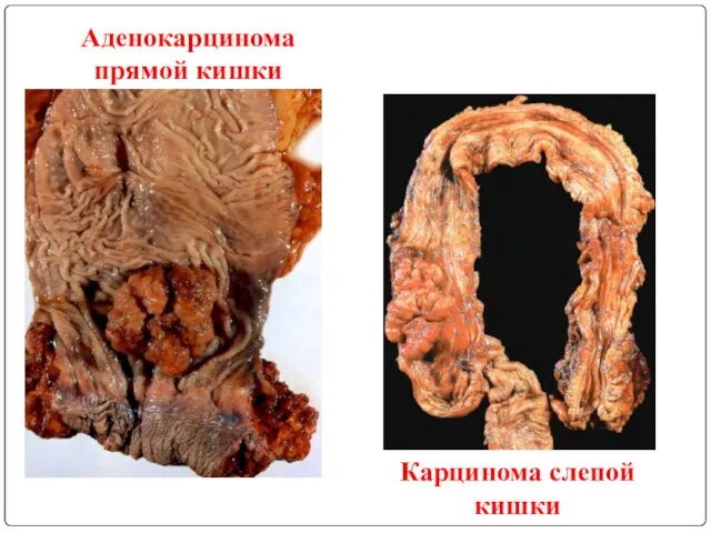 Аденокарцинома прямой кишки Карцинома слепой кишки