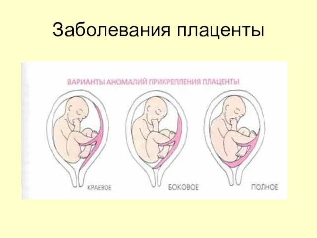 Заболевания плаценты