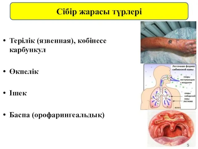 Терілік (язвенная), көбінесе карбункул Өкпелік Ішек Баспа (орофарингеальдық) Сібір жарасы түрлері