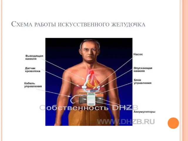 Схема работы искусственного желудочка