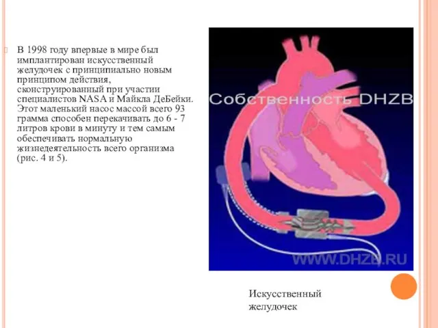 В 1998 году впервые в мире был имплантирован искусственный желудочек с
