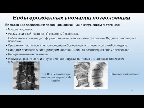 Виды врожденных аномалий позвоночника Врожденные деформации позвонков, связанные с нарушением онтогенеза: