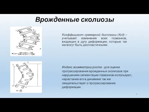 Врожденные сколиозы Коэффициент суммарной дисплазии (Ксд) – учитывает изменения всех позвонков,