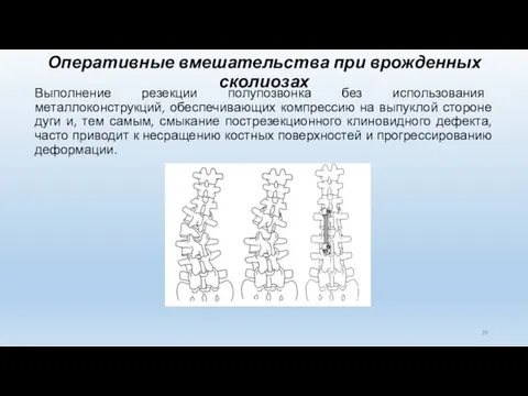 Оперативные вмешательства при врожденных сколиозах Выполнение резекции полупозвонка без использования металлоконструкций,