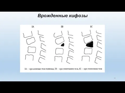 Врожденные кифозы