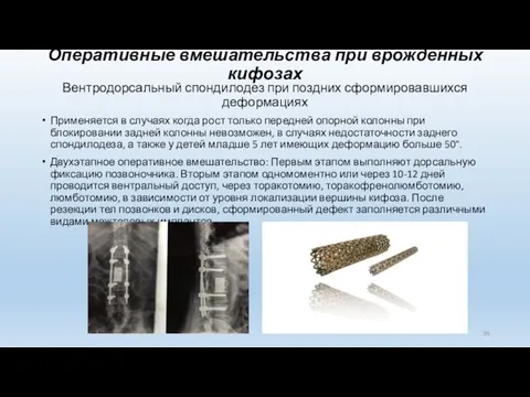 Оперативные вмешательства при врожденных кифозах Вентродорсальный спондилодез при поздних сформировавшихся деформациях