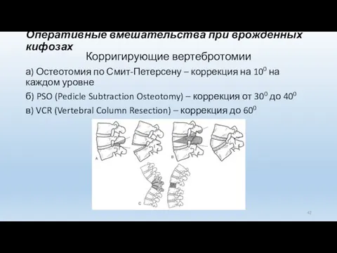 Оперативные вмешательства при врожденных кифозах Корригирующие вертебротомии а) Остеотомия по Смит-Петерсену