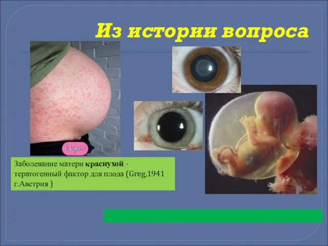 Из истории вопроса Заболевание матери краснухой - тератогенный фактор для плода (Greg,1941 г.Австрия )