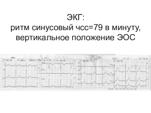 ЭКГ: ритм синусовый чсс=79 в минуту, вертикальное положение ЭОС