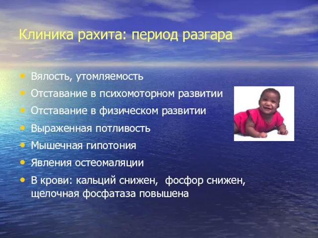 Клиника рахита: период разгара Вялость, утомляемость Отставание в психомоторном развитии Отставание