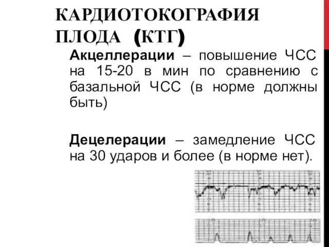 КАРДИОТОКОГРАФИЯ ПЛОДА (КТГ) Акцеллерации – повышение ЧСС на 15-20 в мин