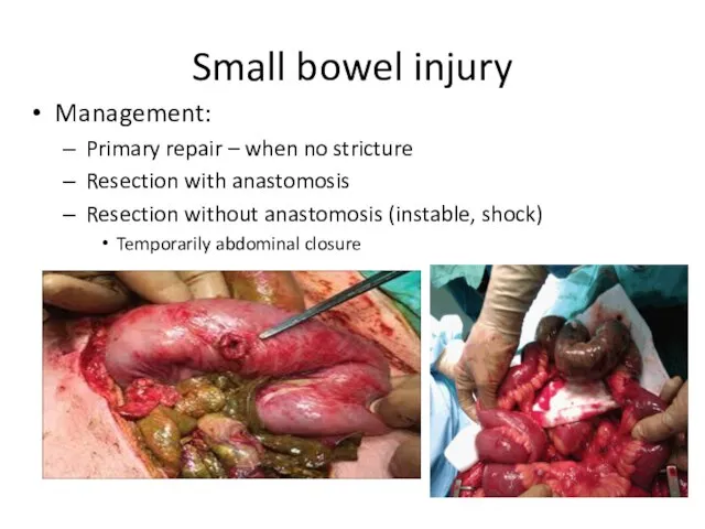 Small bowel injury Management: Primary repair – when no stricture Resection