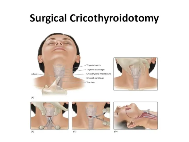 Surgical Cricothyroidotomy