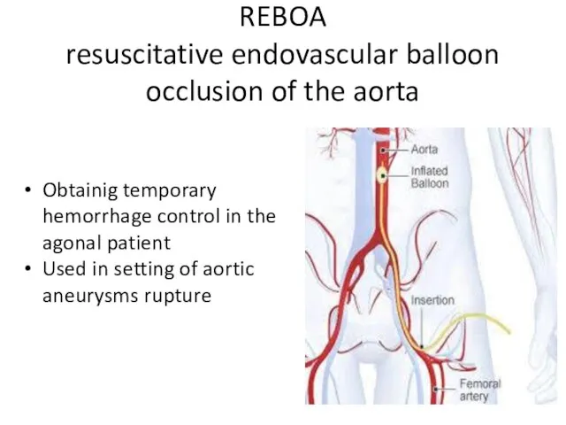 REBOA resuscitative endovascular balloon occlusion of the aorta Obtainig temporary hemorrhage