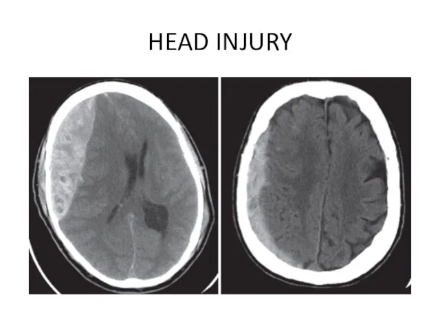 HEAD INJURY