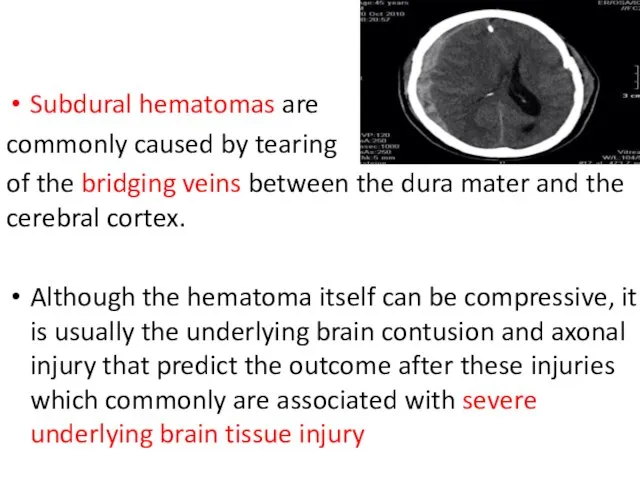 Subdural hematomas are commonly caused by tearing of the bridging veins