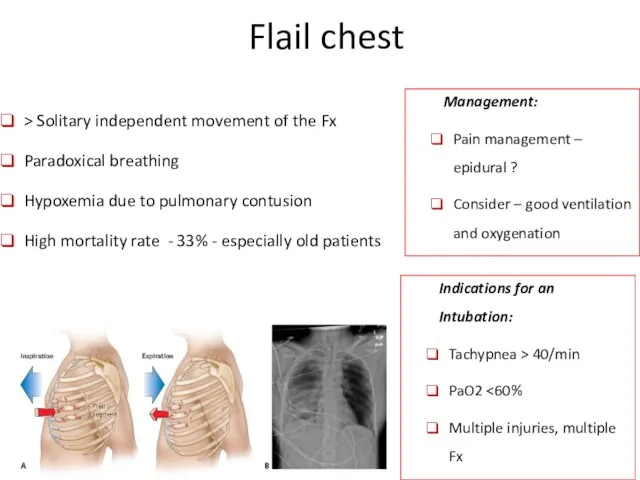 Flail chest > Solitary independent movement of the Fx Paradoxical breathing