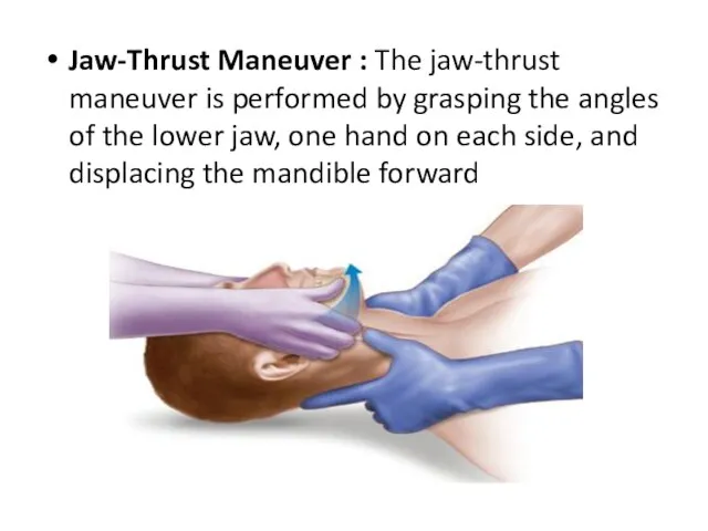 Jaw-Thrust Maneuver : The jaw-thrust maneuver is performed by grasping the