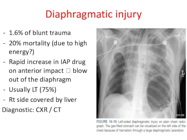 Diaphragmatic injury 1.6% of blunt trauma 20% mortality (due to high