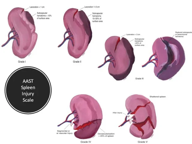 AAST Spleen Injury Scale