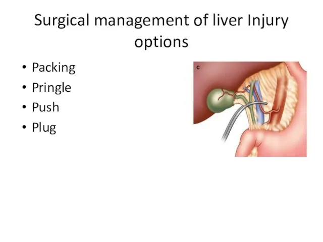 Surgical management of liver Injury options Packing Pringle Push Plug