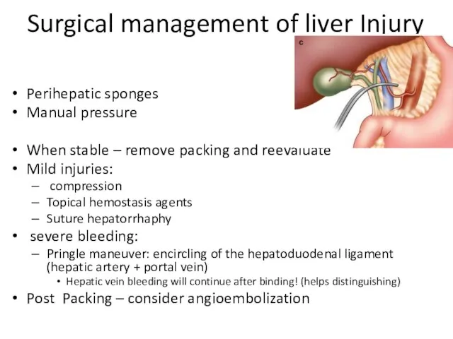 Surgical management of liver Injury Perihepatic sponges Manual pressure When stable