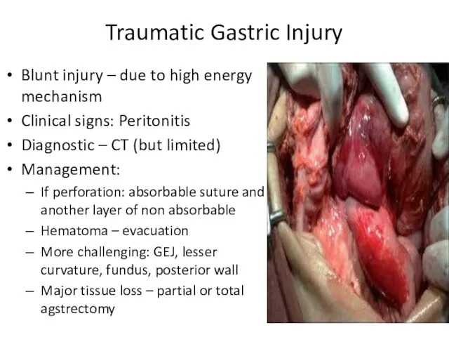 Traumatic Gastric Injury Blunt injury – due to high energy mechanism