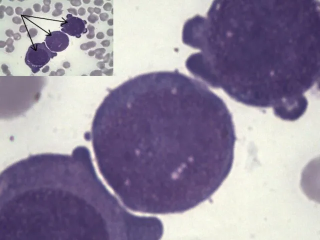 Бластные клетки при ОПЛ (микрофотография)