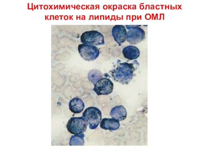 Цитохимическая окраска бластных клеток на липиды при ОМЛ