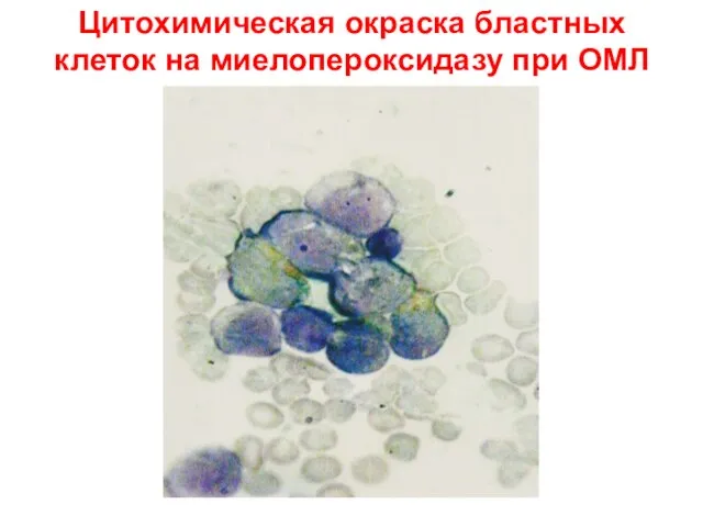 Цитохимическая окраска бластных клеток на миелопероксидазу при ОМЛ