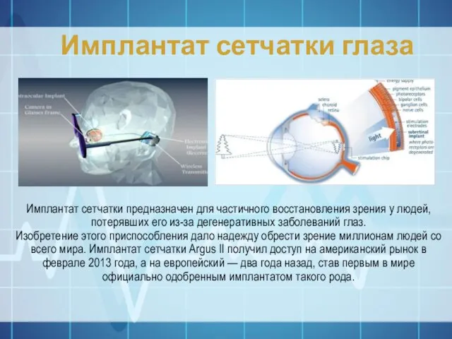 Имплантат сетчатки глаза Имплантат сетчатки предназначен для частичного восстановления зрения у