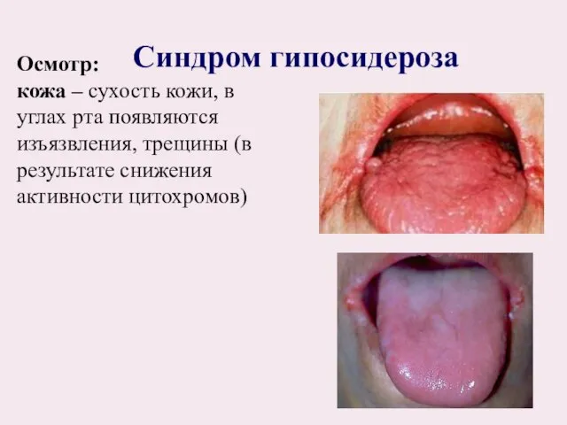 Осмотр: кожа – сухость кожи, в углах рта появляются изъязвления, трещины