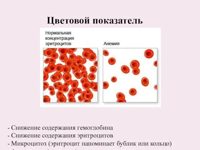 - Снижение содержания гемоглобина - Снижение содержания эритроцитов - Микроцитоз (эритроцит