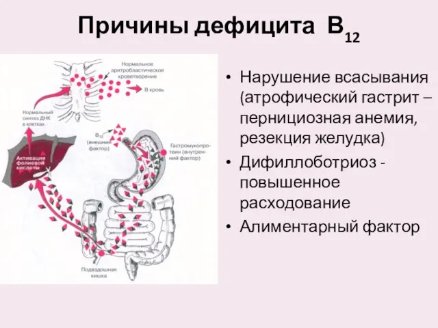 Причины дефицита В12 Нарушение всасывания (атрофический гастрит – пернициозная анемия, резекция