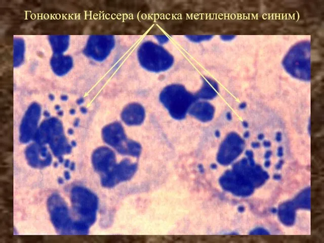 Гонококки Нейссера (окраска метиленовым синим)