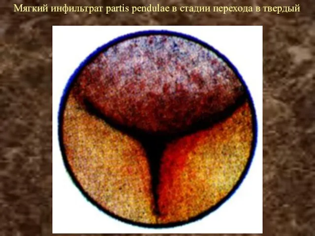 Мягкий инфильтрат partis pendulae в стадии перехода в твердый