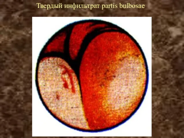 Твердый инфильтрат partis bulbosae